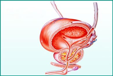 Peradangan prostat pada prostatitis akut merupakan batasan dalam berhubungan seks