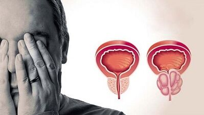 Alasan pengembangan prostatitis pada pria