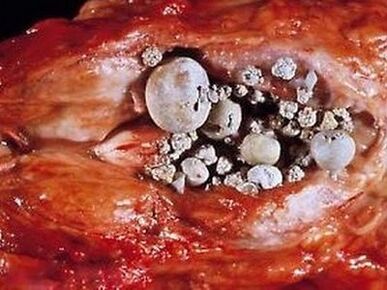 Batu di kelenjar prostat dengan prostatitis kalsifikasi
