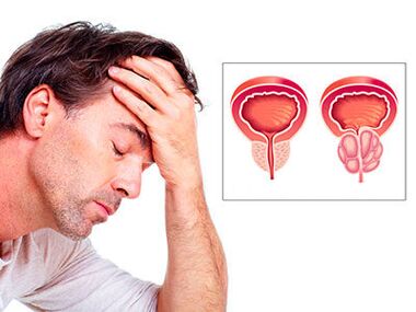 Gejala prostatitis membuat khawatir seorang pria